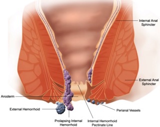 hemorrhoids and functional health