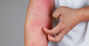 Natural Treatments For Eczema